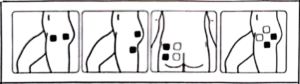 محل قرارگیری پدهای الکترود در ناحیه باسن برای دستگاه فیزیوتراپی و تنس جامپر مدل JPD-ES220 — k-teb.com